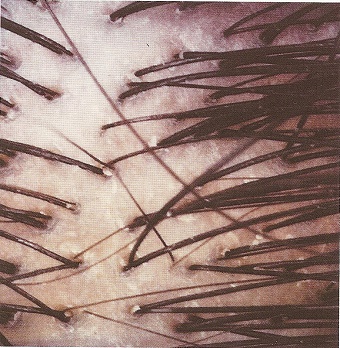 scalp3