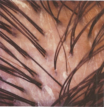 scalp4