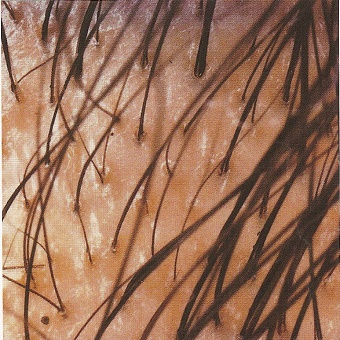 scalp6