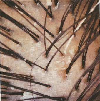 scalp7